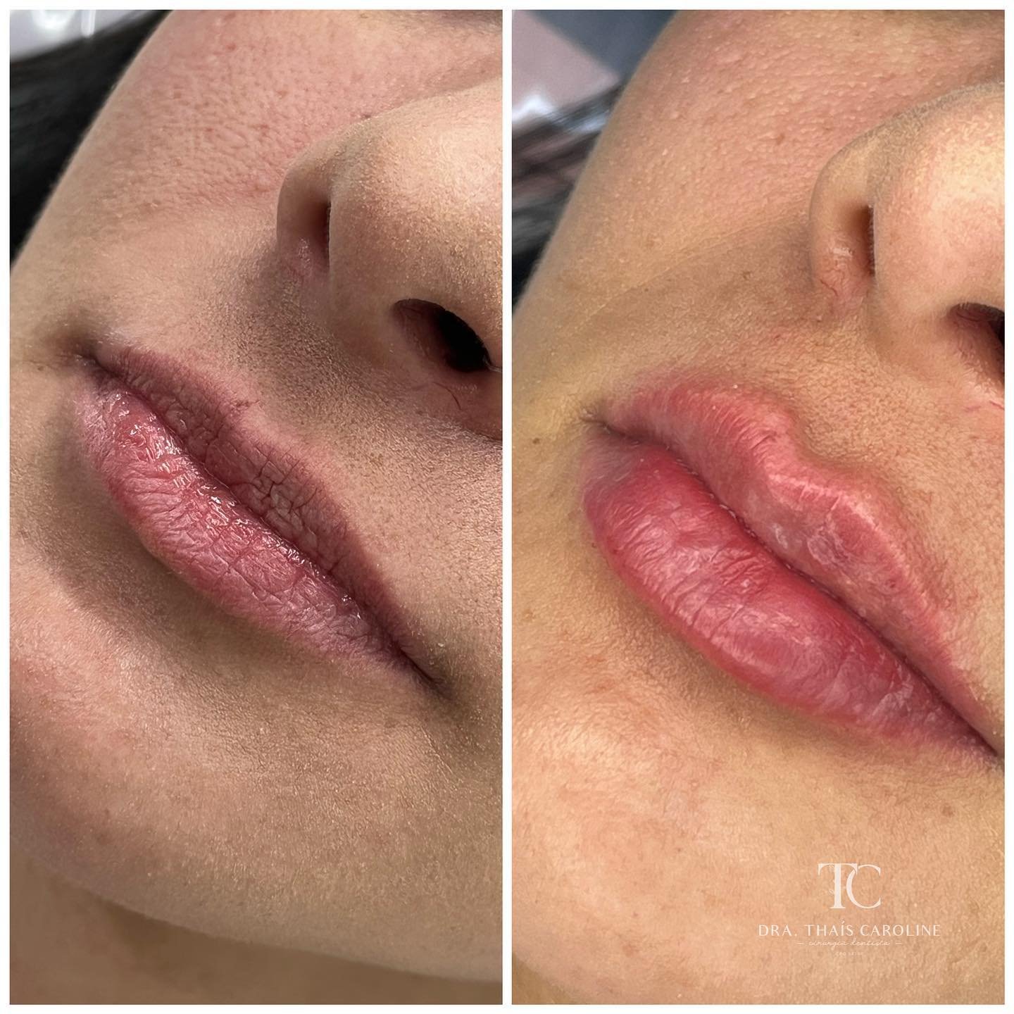 Curso Construindo Lábios - Dra. Thaís Carolinee
