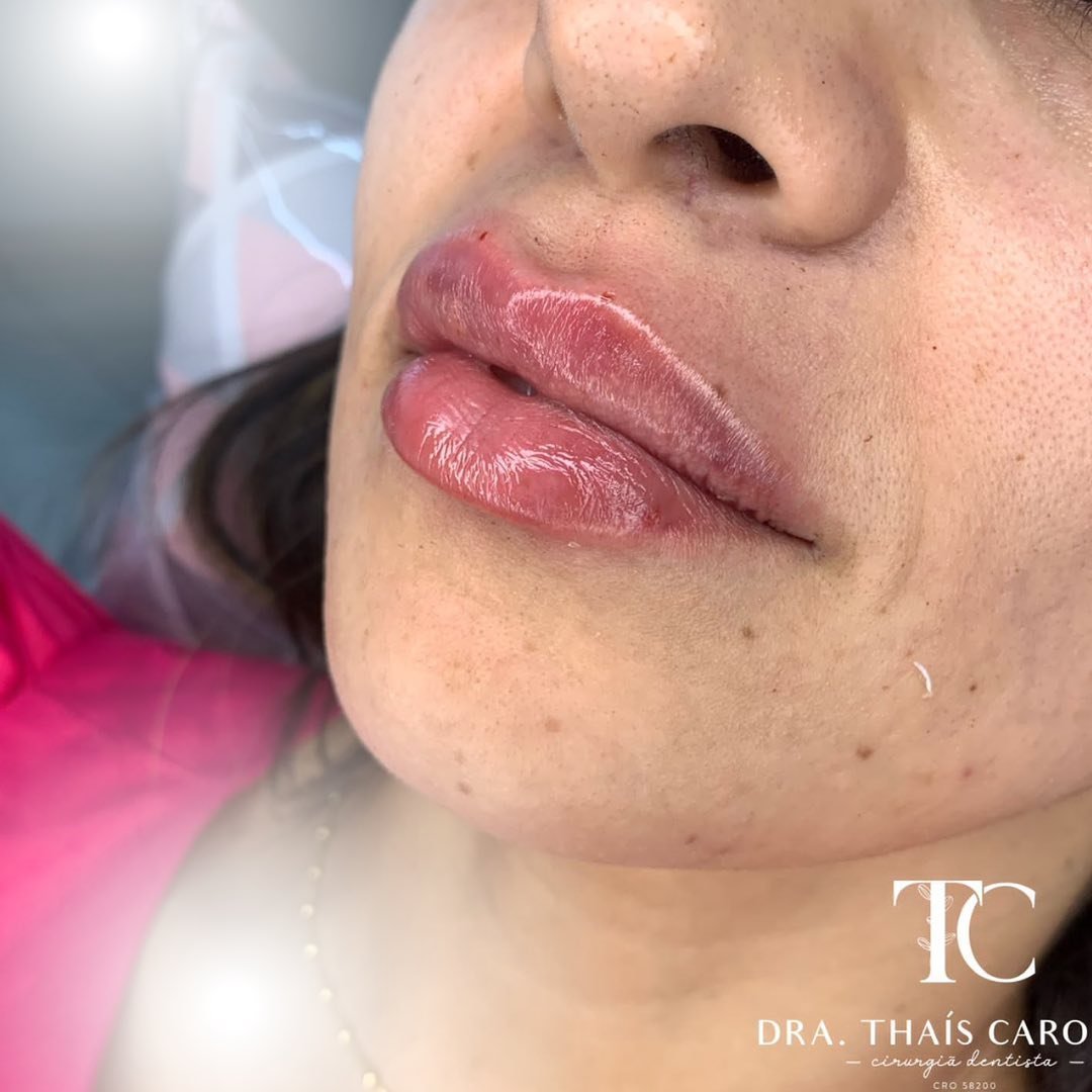 Curso Construindo Lábios - Dra. Thaís Carolinee