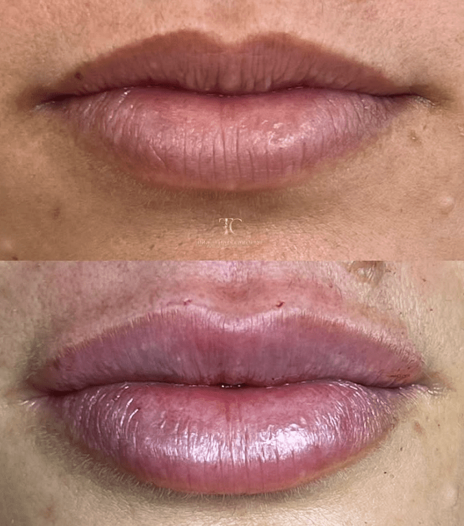 Curso Construindo Lábios - Dra. Thaís Carolinee