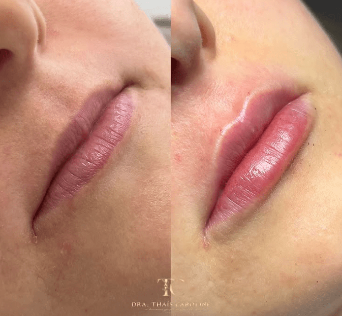 Curso Construindo Lábios - Dra. Thaís Carolinee
