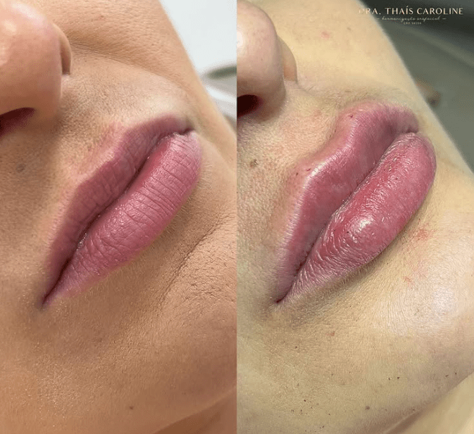 Curso Construindo Lábios - Dra. Thaís Carolinee