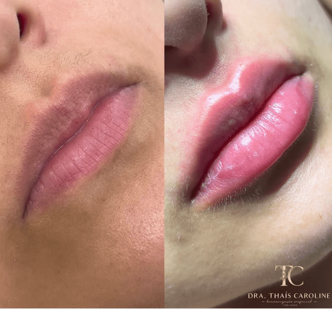 Curso Construindo Lábios - Dra. Thaís Carolinee