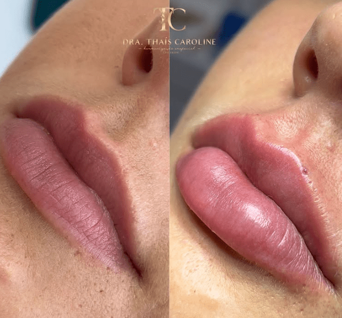 Curso Construindo Lábios - Dra. Thaís Carolinee