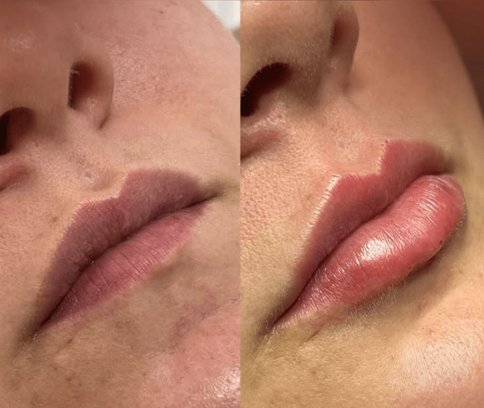 Curso Construindo Lábios - Dra. Thaís Carolinee