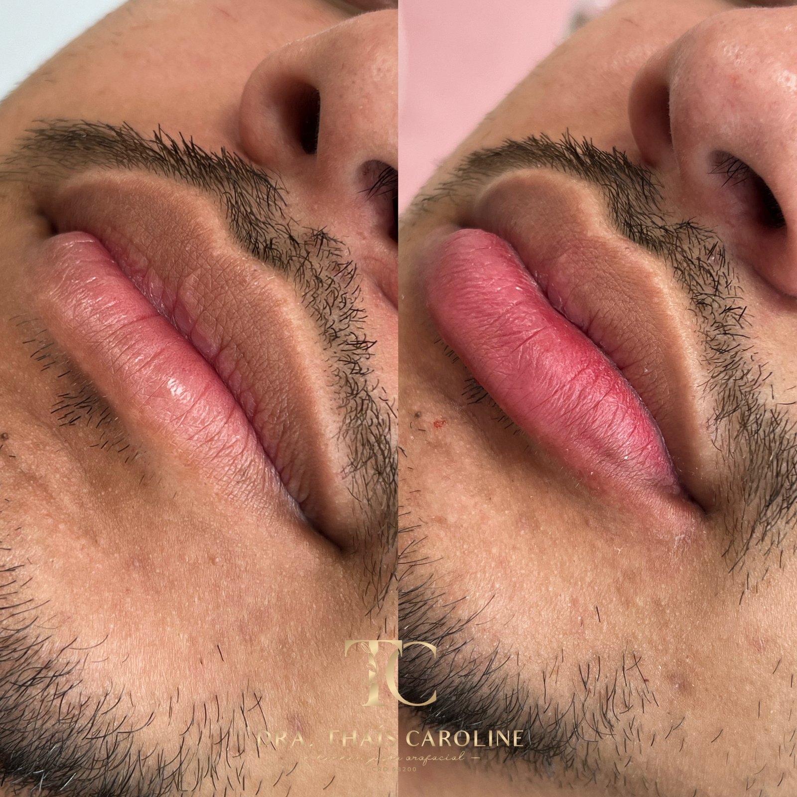 Resultado antes e depois da metodologia Construindo Lábios
